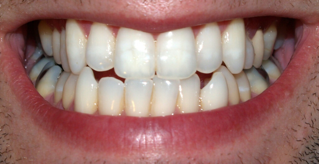 Human Teeth Wikidoc