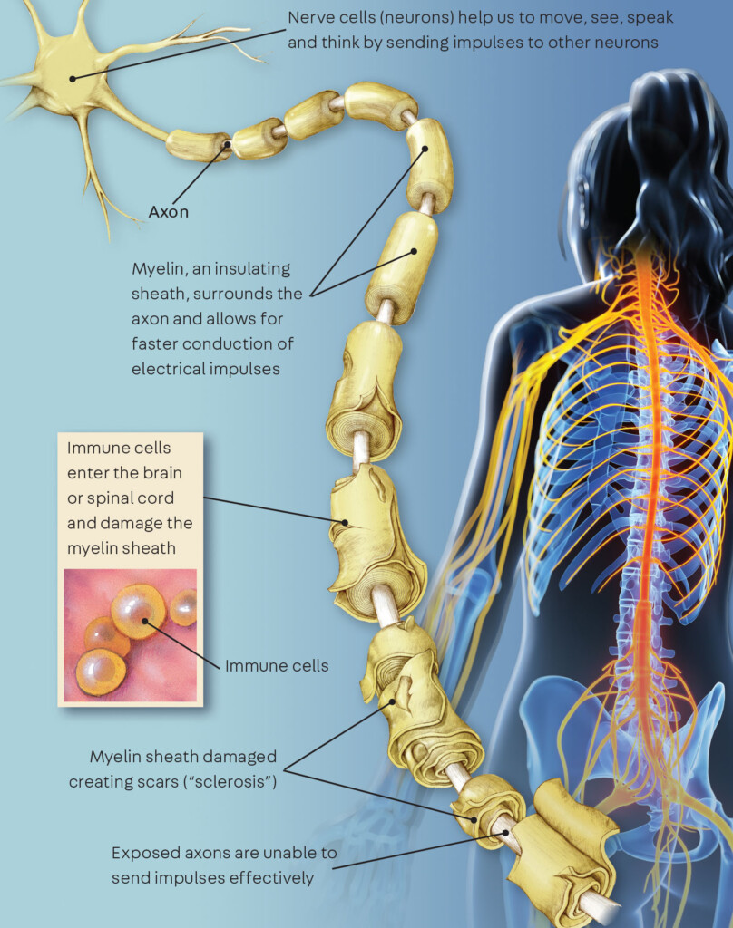Multiple Sclerosis 101 What Patients Need To Know